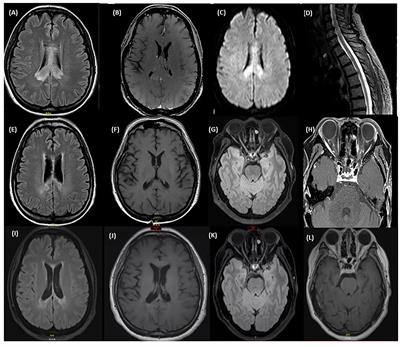 Chronic Cognitive Impairment in AQP4+ NMOSD With Improvement in Cognition on Eculizumab: A Report of Two Cases